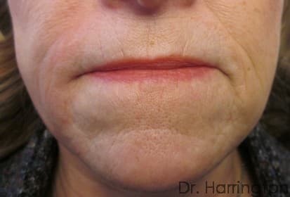Face case #121 after