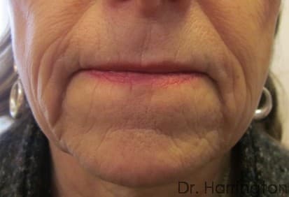 Face case #121 before