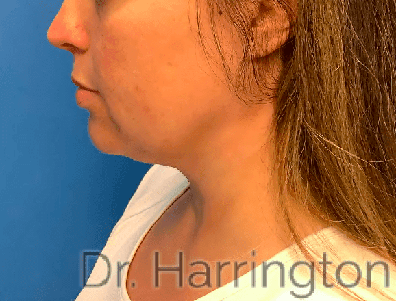 Face case #7994 after