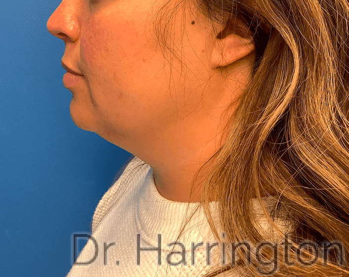 Face case #7994 before