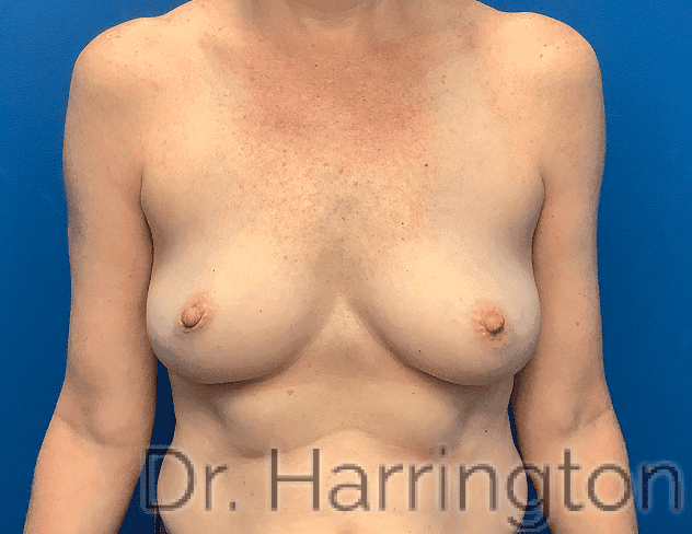 Breast case #8032 before