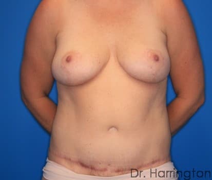 Breast case #130 after