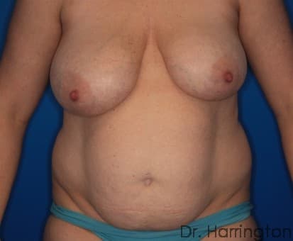 Breast case #130 before