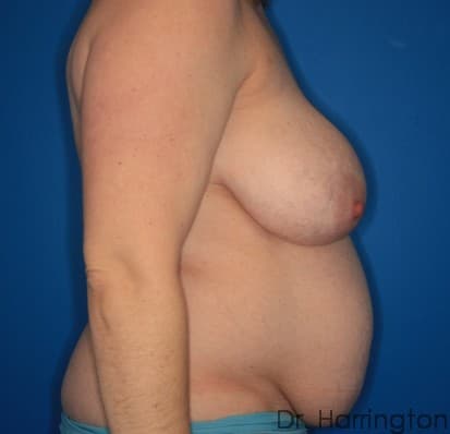 Breast case #130 before, image 2