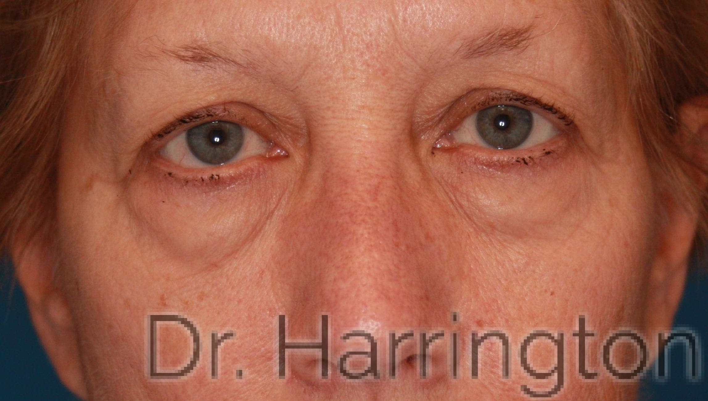 Face case #169 before