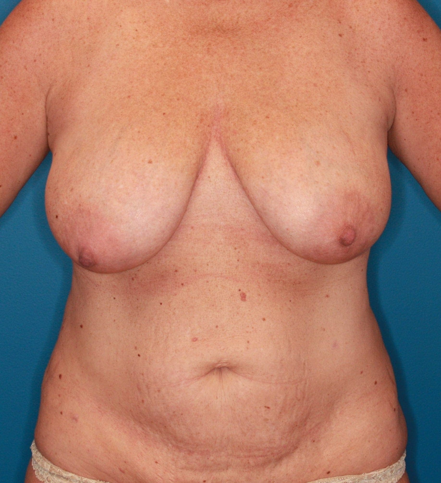 Body case #164 after