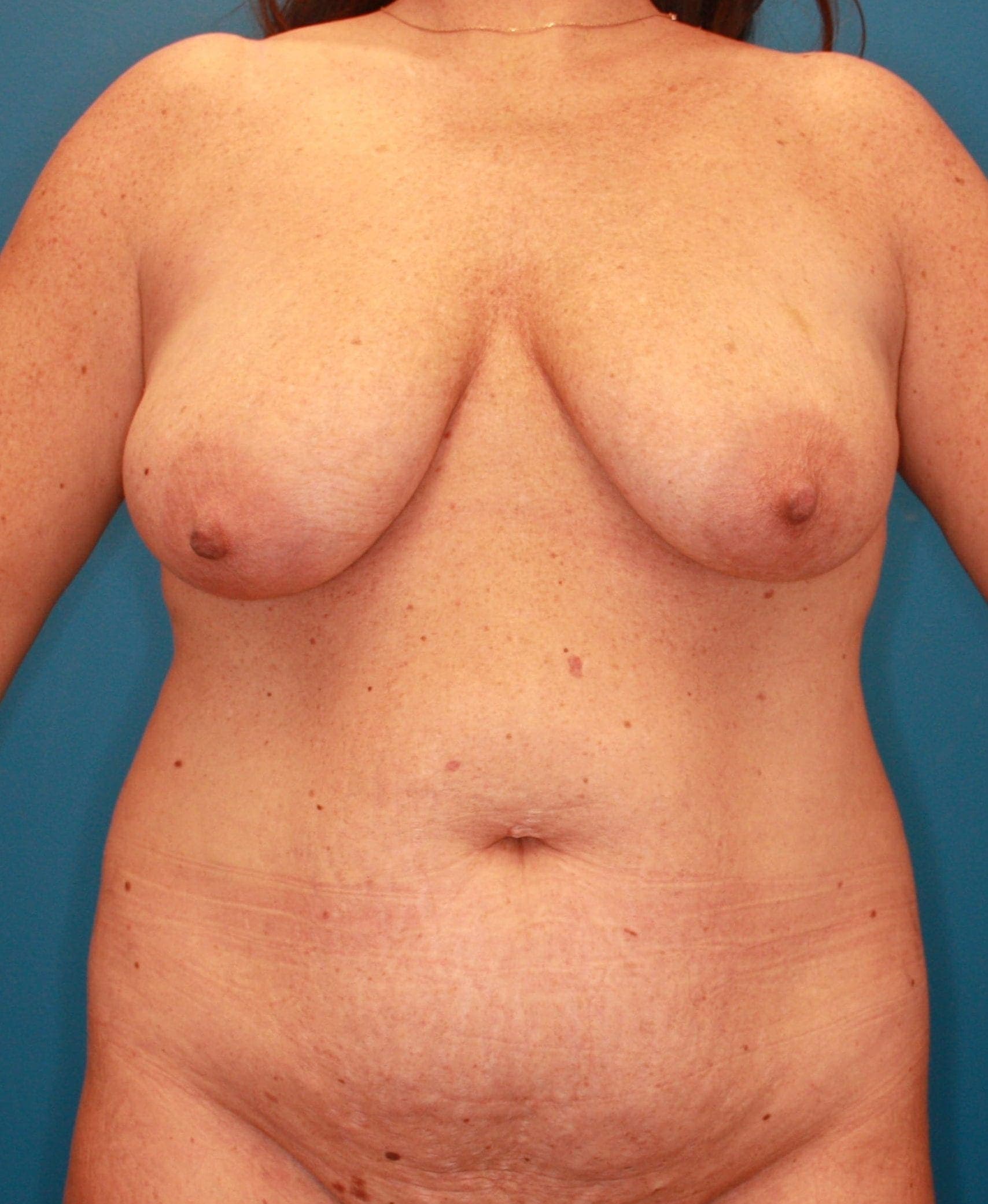 Body case #164 before