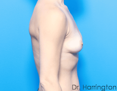 Breast case #65 before, image 2