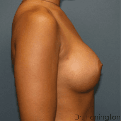 Breast case #71 after, image 2
