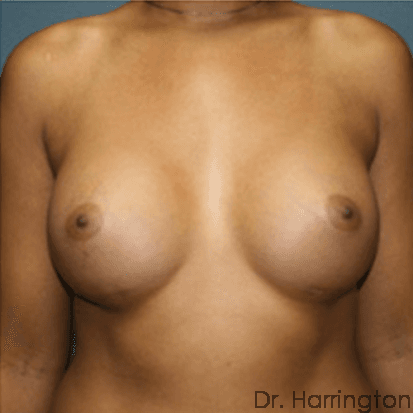 Breast case #71 after