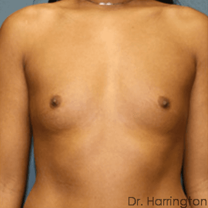 Breast case #71 before