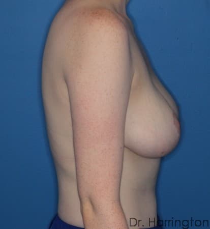 Breast case #107 after, image 3