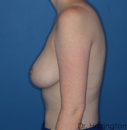 Breast case #107 after, image 2