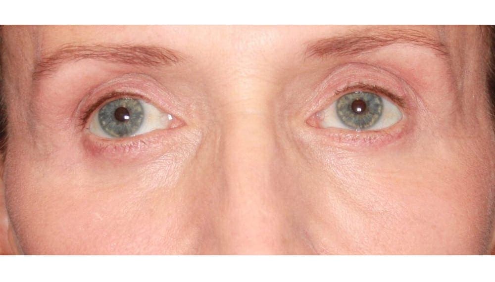 Face case #160 after