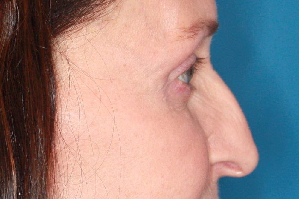Face case #160 after, image 3