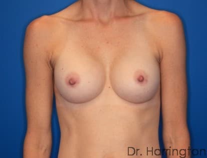 Breast case #132 after