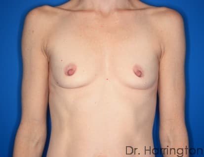 Breast case #132 before