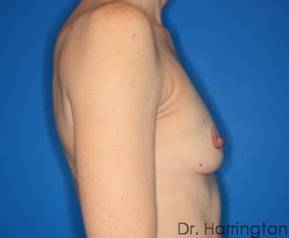 Breast case #132 before, image 2