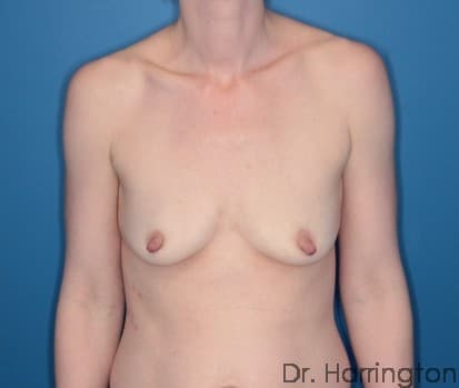 Breast case #112 before