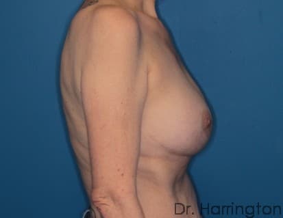 Breast case #116 before, image 3