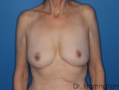 Breast case #116 after