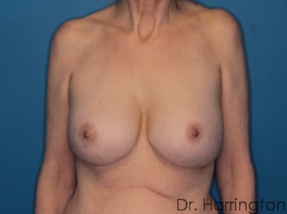 Breast case #116 before