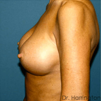 Breast case #68 after, image 2