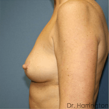 Breast case #68 before, image 2