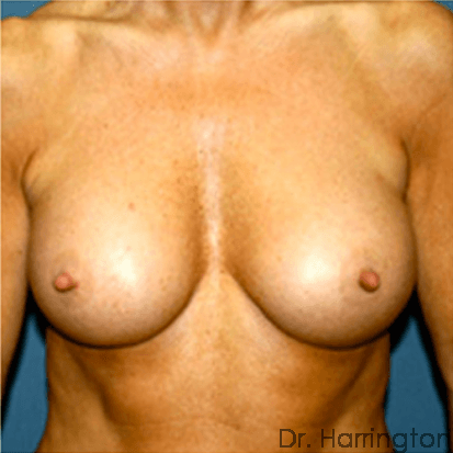 Breast case #68 after