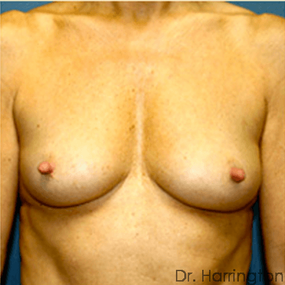 Breast case #68 before