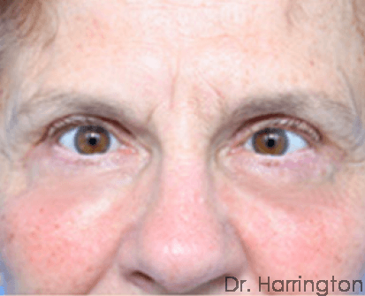 Face case #62 after