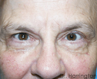 Face case #62 before