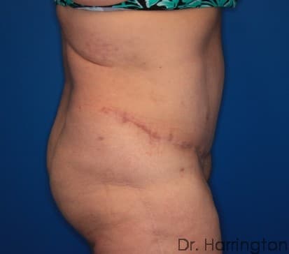 Body case #128 after, image 2