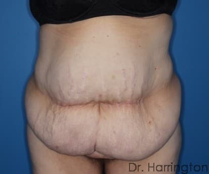 Body case #128 before