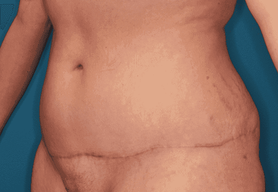 Body case #158 after, image 2