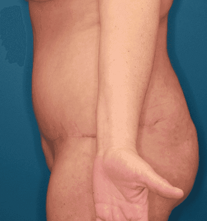 Body case #158 after, image 3