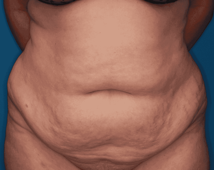 Body case #158 before