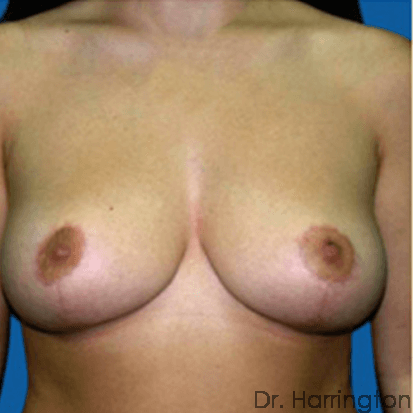 Breast case #75 after