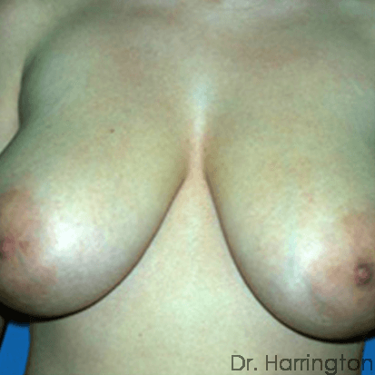 Breast case #75 before
