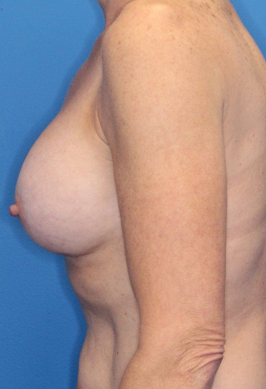 Breast case #173 after, image 3