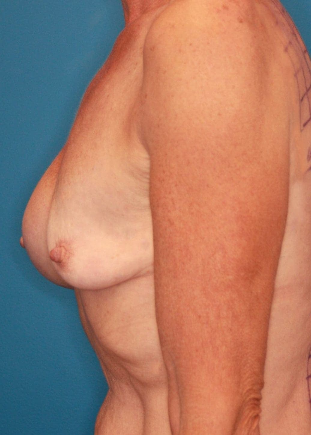 Breast case #173 before, image 3