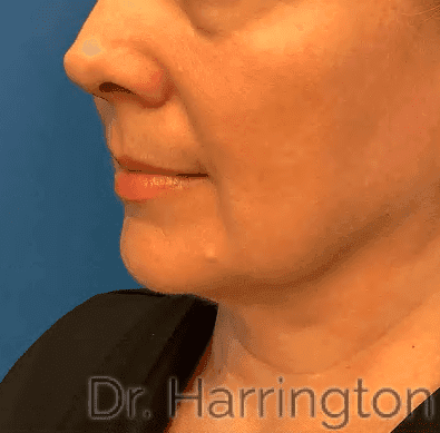 Face case #8020 after