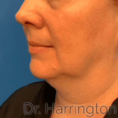 Face case #8020 before