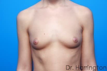 Breast case #88 before