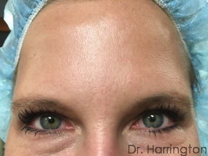 Face case #100 after