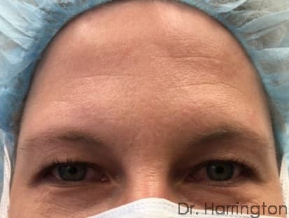 Face case #100 before