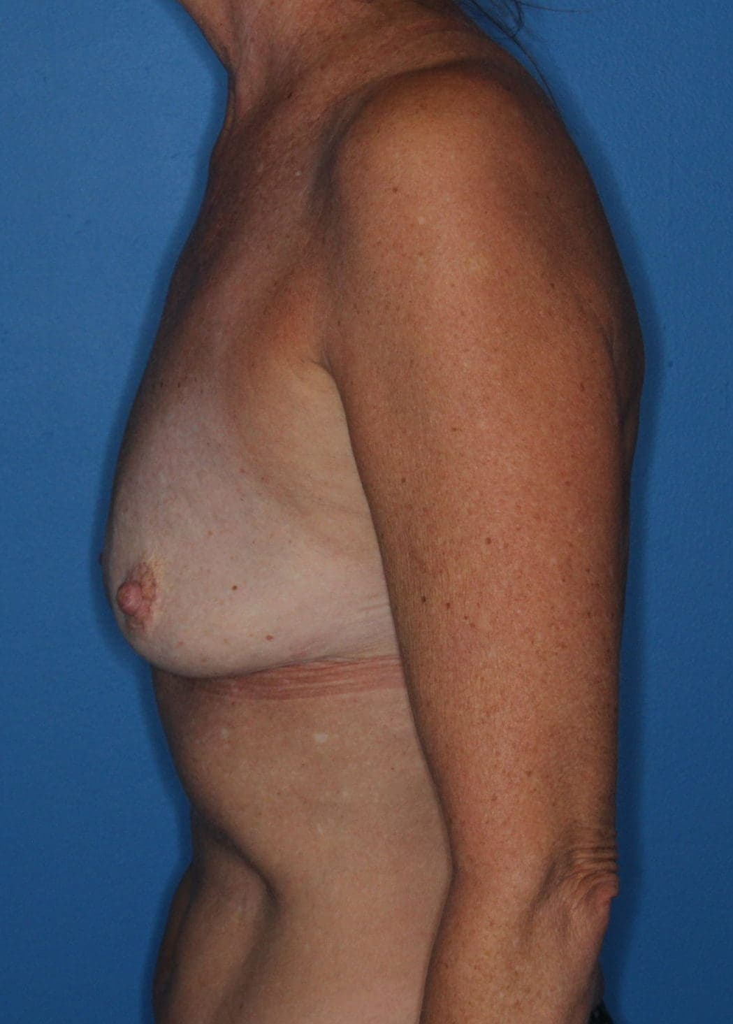 Breast case #172 before, image 2