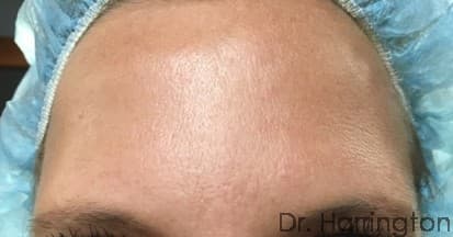 Face case #101 after