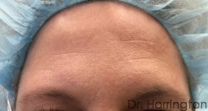 Face case #101 before