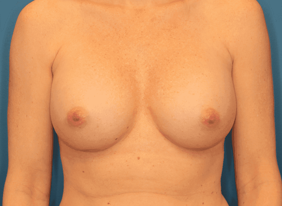 Breast case #162 after